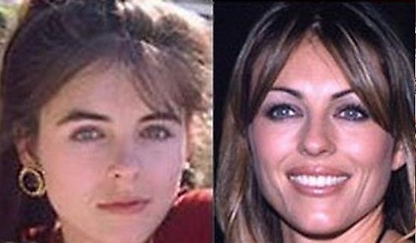 plastic surgery 03 Top 16 Celebrities Before and Ater Plastic Surgery