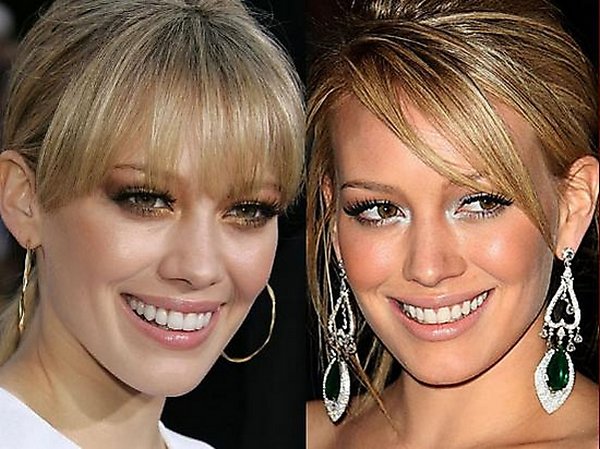 plastic surgery 05 Top 16 Celebrities Before and Ater Plastic Surgery