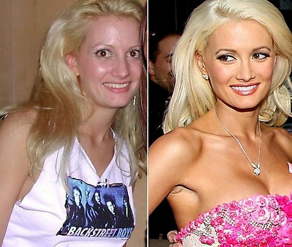 plastic surgery 06 Top 16 Celebrities Before and Ater Plastic Surgery