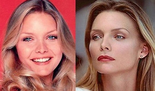 plastic surgery 10 Top 16 Celebrities Before and Ater Plastic Surgery