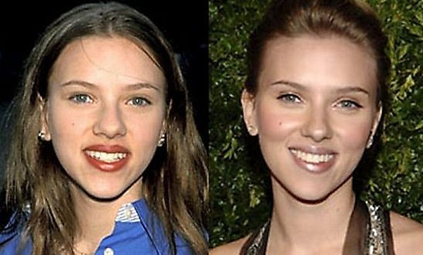 plastic surgery 12 Top 16 Celebrities Before and Ater Plastic Surgery
