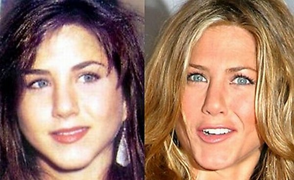 plastic surgery 13 Top 16 Celebrities Before and Ater Plastic Surgery