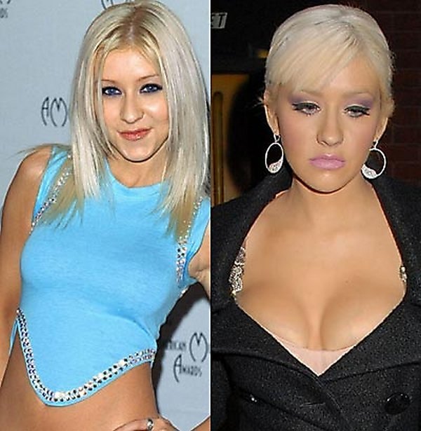plastic surgery 16 Top 16 Celebrities Before and Ater Plastic Surgery